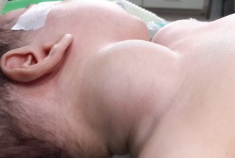 Best Pediatric Urologist in Ahmedabad, Child Urologist in Ahmedabad, Hirschsprung’s disease in Rajasthan, Hirschsprung Disease Treatment