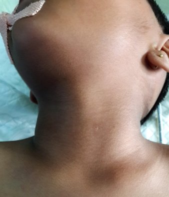 Best Pediatric Urologist in Ahmedabad, Child Urologist in Ahmedabad, Hirschsprung’s disease in Rajasthan, Hirschsprung Disease Treatment