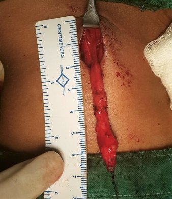 Best Pediatric Urologist in Ahmedabad, Child Urologist in Ahmedabad, Hirschsprung’s disease in Rajasthan, Hirschsprung Disease Treatment