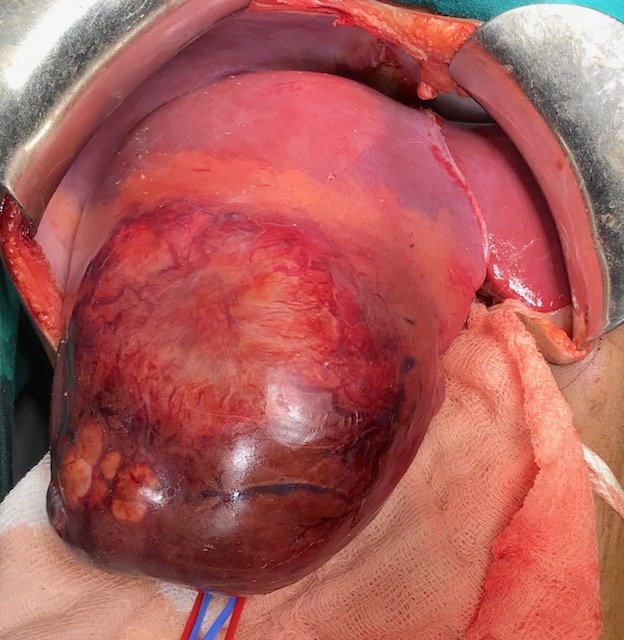 Operative Photograph showing Large Tumor arising from right lobe of Liver Operative Photograph showing Large Tumor arising from right lobe of Liver