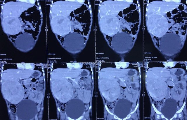 CT Scan of Abdomen showing Large Liver Tumor arising rom right lobe of Liver CT Scan of Abdomen showing Large Liver Tumor arising rom right lobe of Liver