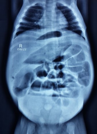 Best Pediatric Urologist in Ahmedabad, Child Urologist in Ahmedabad, Hirschsprung’s disease in Rajasthan, Hirschsprung Disease Treatment