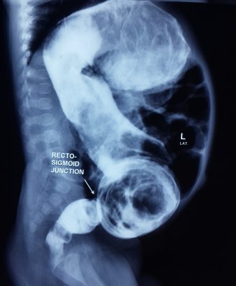 Pediatric Hospital in Ahmedabad, Child Care Hospital Ahmedabad, Hirschsprung'S Disease Surgery in Rajasthan