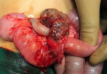 Best Pediatric Urologist in Ahmedabad, Child Urologist in Ahmedabad, Hirschsprung’s disease in Rajasthan, Hirschsprung Disease Treatment