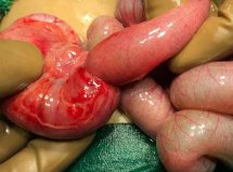 Best Pediatric Urologist in Ahmedabad, Child Urologist in Ahmedabad, Hirschsprung’s disease in Rajasthan, Hirschsprung Disease Treatment