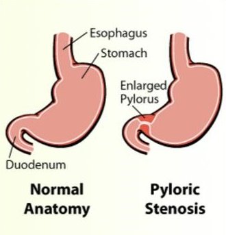 Pyloric Stenosis Pyloric Stenosis