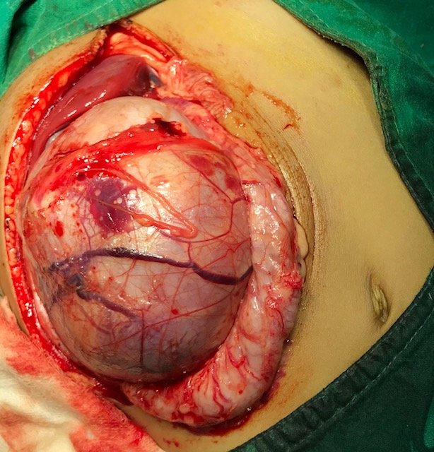 Operative Photo showing Massive Tumor Operative Photo showing Massive Tumor