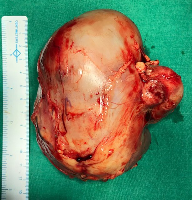 Completely Excised Tumor Completely Excised Tumor