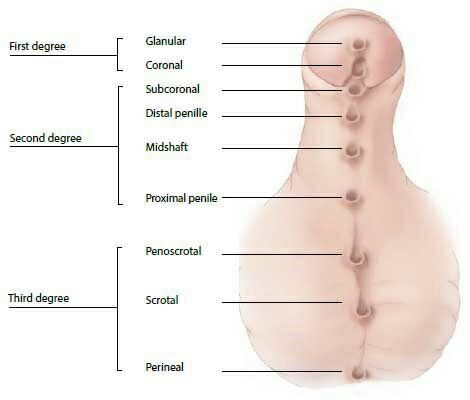 Hypospadias surgery in Ahmedabad, Gujarat Hypospadias surgery in Ahmedabad, Hypospadias surgery in Gujarat, Hypospadias surgery in Rajasthan, best hypospadias surgeon in Rajasthan