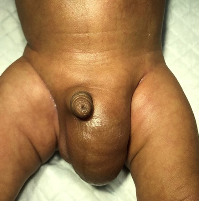 Left Inguinal Hernia