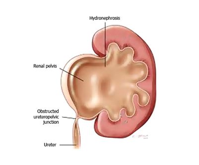 Best Pediatric Urologist in Ahmedabad, Child Urologist in Ahmedabad, Hirschsprung’s disease in Rajasthan, Hirschsprung Disease Treatment